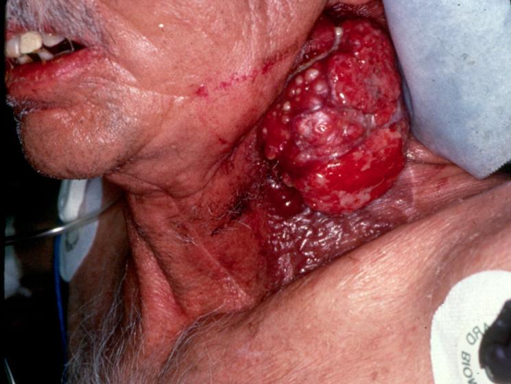 Steißbein tumor symptome